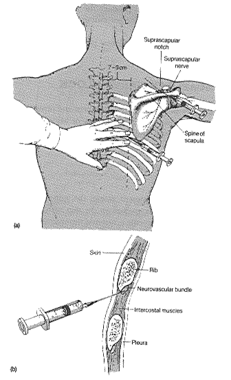 Ache under outlet arm