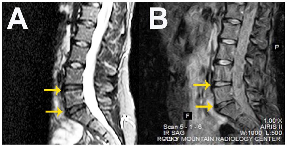 Stem Cell Treatment for Back Pain Shows Success