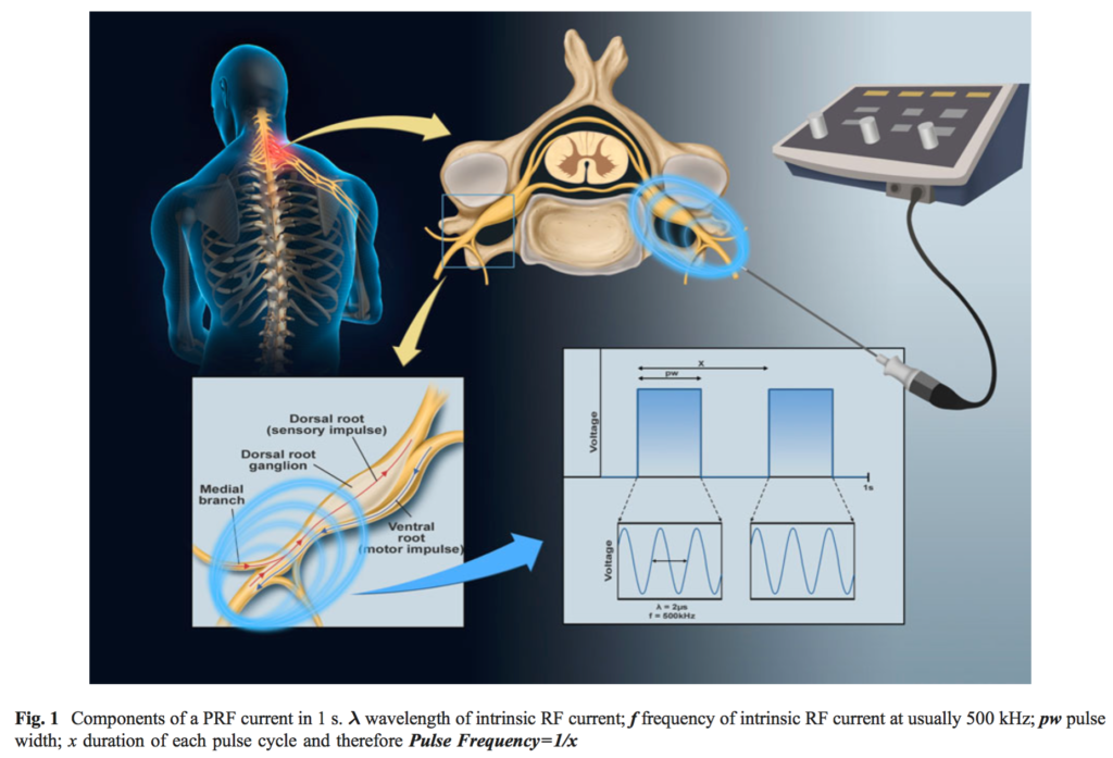 Pulsed Radiofrequency Treatment