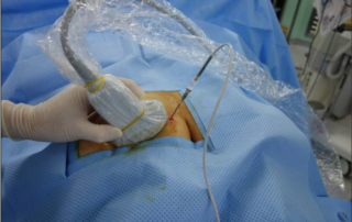 Pulsed Radiofrequency Treatment (PRF) of the Pudendal Nerve