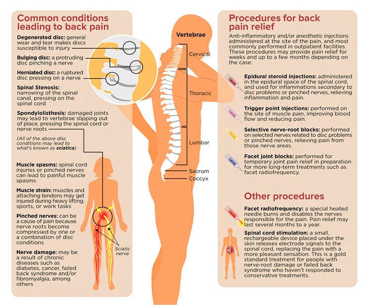 Lower Back Pain: What Could It Be?